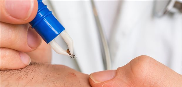 Keine Antibiotika bei Antibiotika-refraktärer Lyme-Arthritis! Eine Zecke wird mit einer Zange aus der Haut entfernt.