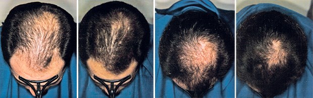 Finasteride bestellen