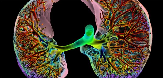 Wenn bei Rheuma die Lunge knistert Darstellung einer Lunge: Farbige 3D-Computertomographie (CT) in axialer Ebene bei interstitieller Lungenerkrankung (ILD).