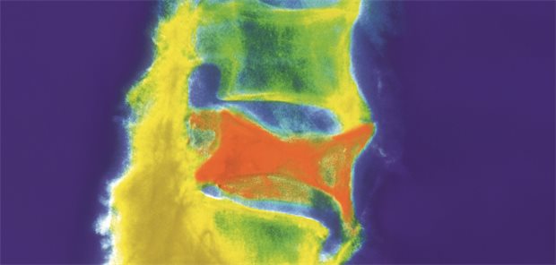 Osteoporose: So verhindern Sie die (nächste) Fraktur Farbige Röntgenaufnahme der Lendenwirbelsäule mit einem Kompressionsbruch