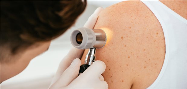 Nachsorge von Melanomen: Bildgebung womöglich nutzlos Nahaufnahme eines Dermatologen der ein Dermatoskop verwendet um die Haut eines Patienten zu untersuchen.