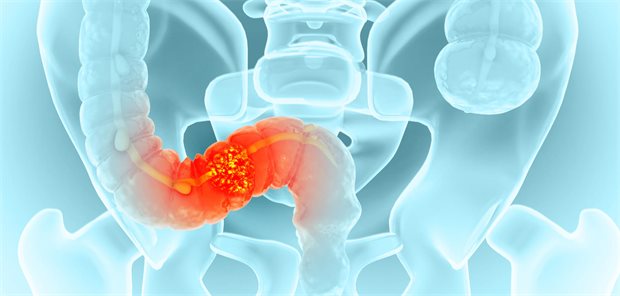 Kolorektales Karzinom: Was der Paradigmenwechsel bei T1-Tumoren bedeutet Hervorgehobenes Schema eines kolorektalen Tumors