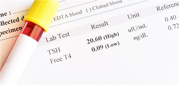Fehldiagnose Hypothyreose bringt Frau in Lebensgefahr Ergebnis eines Hypothyreose-Test mit einer Blutprobe.
