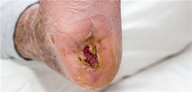 Diabetischer Fuß: SGLT2-Inhibitoren schneiden etwas besser ab als GLP-1-Rezeptoragonisten Fußläsion