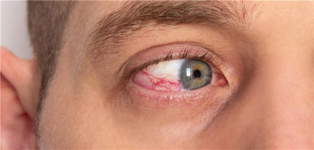 Senken GLP-1-Agonisten das Uveitisrisiko? Nahaufnahme eines roten männlichen Auges mit beschädigten Blutgefäßen aufgrund einer Uveitis.