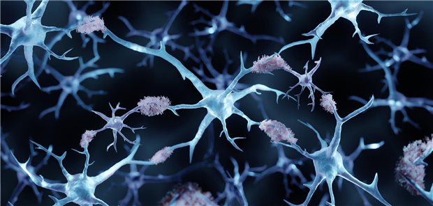 Cochrane-Review: Amyloid-Antikörper bei Alzheimer kaum wirksam Amyloid Ablagerungen an Neuronen.