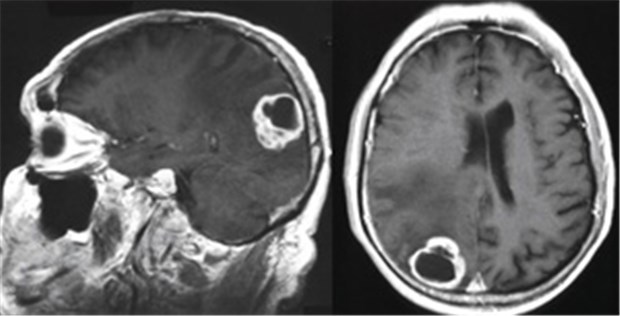 Hirntumor Patienten Fragen Oft Alternative Heilmethoden Nach