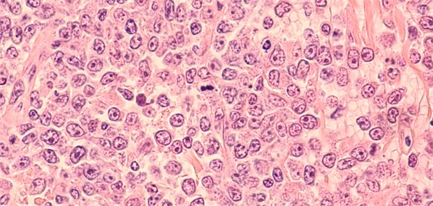 CAR-T-Zellen gegen B-Zell-Lymphome: „Außergewöhnlich lange Remissionen“ Großzelliges B-Zell-Lymphom