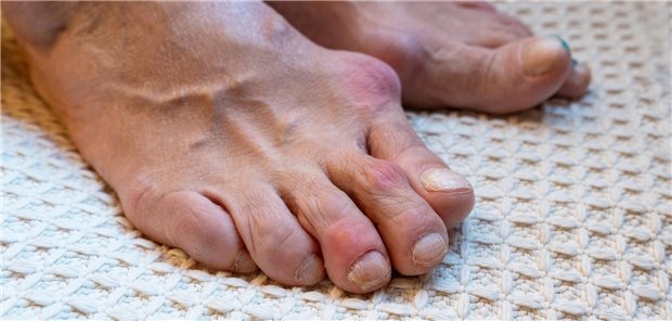 Hallux valgus ist eine Folge, wenn bei Patienten mit Rheumatoider Arthritis das Fußquergewölbe abflacht, bis zur plantaren Konvexität.