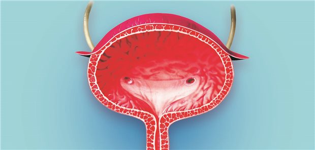 Harnblase: Schmerzen, Pollakisurie, Nykturie und imperativer Harndrang können Symptome einer Zystitis, aber auch einer nichtinfektiösen chronischen Harnblasenerkrankung sein, der interstitiellen Zystitis/Blasenschmerzsyndrom (IC/BPS).