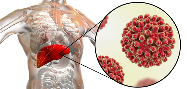 Hepatitis B: allein in Deutschland sind rund 16.000 Menschen betroffen.