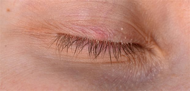 Demodex-Milben am Lidrand häufiger als gedacht Demodex-Milbenbefall am Auge, verklebte Wimpern und eine rote Stelle auf dem Oberlid.