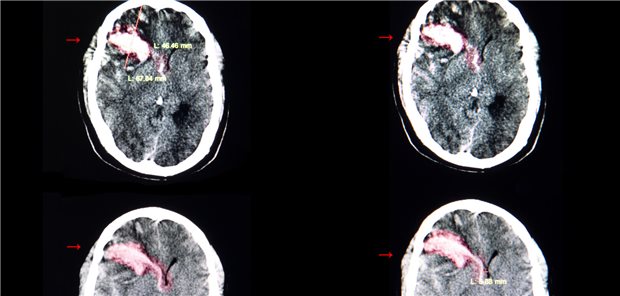 Die Autorinnen und Autoren resümieren, dass auf der Grundlage ihrer Ergebnisse Tranexamsäure nicht routinemäßig bei primären intrazerebralen Blutungen eingesetzt werden sollte.