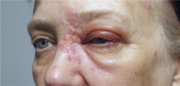 Auch ohne Zoster-Bläschen an der Nase kann das Auge beteiligt sein Hutchinson-Zeichen entlang der Nasenwurzel: In einer Metaanalyse wurde sein prognostischer Nutzen für eine Augenbeteiligung neu bewertet. Der positive Vorhersagewert ist demnach hoch. Seine Abwesenheit schließt Augenkomplikationen jedoch nicht verlässlich aus.