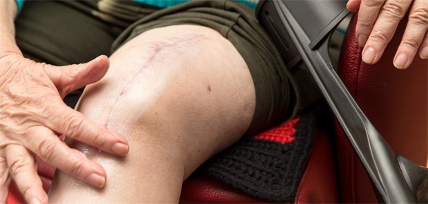 Kniegelenkarthrose: Stoßdämpfer hilft wohl, die Knie-TEP zu verzögern Eine Frau mit Narbe am Knie.