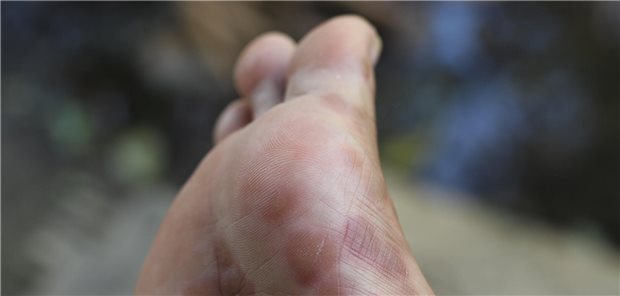 Prävention des Chemotherapie-induzierten Hand-Fuß-Syndroms Entzündete und geschädigte Fußhaut infolge einer Chemotherapie.