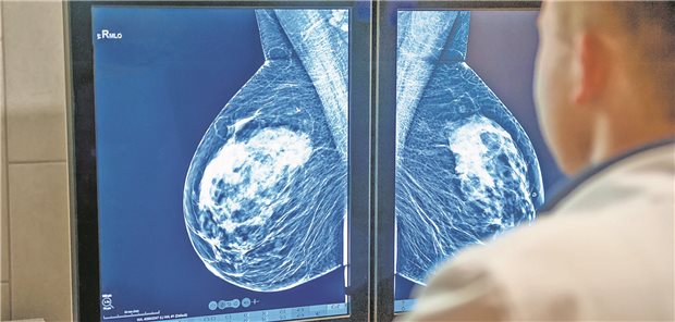 Frühes HR+, HER2- Mammakarzinom: Erfolge auch ohne Chemotherapie möglich Ein Arzt beguachtet die Bilder eines Mammografie-Screenings.