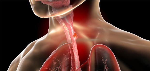Modell eines Ösophaguskarzinoms