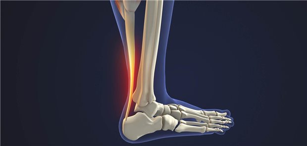 Sieben Jahre extreme Achillodynie durch Ciprofloxacin: Das brachte die Heilung Dreidimensionale gerenderte Darstellung einer Entzündung der Achillessehne.