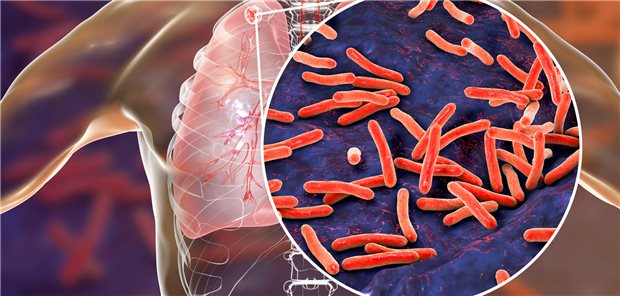 WHO Europa: Jeder fünfte Tuberkulose-Fall bleibt unerkannt Lunge mit Tuberkulose-Bakterien