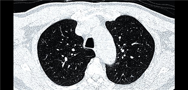 Insgesamt 11,1 Prozent aller Untersuchten präsentierten im CT klinisch relevante Knötchen, die in der Regel weitere Untersuchungen nach sich ziehen.
