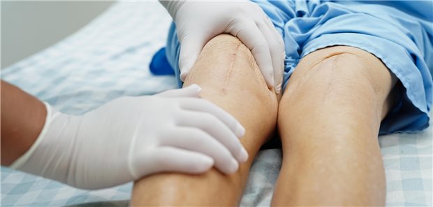 Tourniquet beim Kniegelenkersatz: „Mehr Schaden als Nutzen!“ Ein Arzt untersucht im Krankenhaus eine ältere Patientin, die eine Narbe von einer Kniegelenkersatzoperation am Knie aufweist.