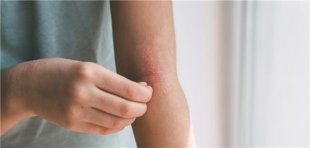 Juckreiz, Rötungen, Schmerzen: Bei atopischer Dermatitis sind oft orale Kortikosteroide angezeigt. Eine längere Einnahme erhöht das Risiko für Komplikationen an den unterschiedlichsten Organen.