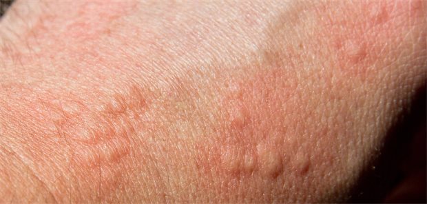 Neue Therapieoptionen bei chronischer spontaner Urtikaria Quaddeln auf der Haut.