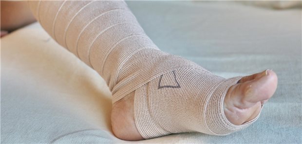 Ulcus cruris venosum: Was für die Kompressionstherapie wichtig ist Ein einbandagierter Fuß