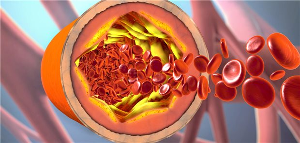 Was bringt ein opportunistisches Screening auf familiäre Hypercholesterinämie? Plaques in Gefäßen