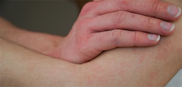 Antihistaminika bringen bei atopischer Dermatitis wohl nichts Eine Hand mit geröteten Stellen liegt auf einem Arm, der ebenfalls gerötete Stellen aufweist.