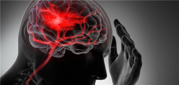 Analyse: Schlaganfall-Risiko in den Monaten nach Krebsdiagnose verdoppelt Darstellung: Schlaganfall im Gehirn.