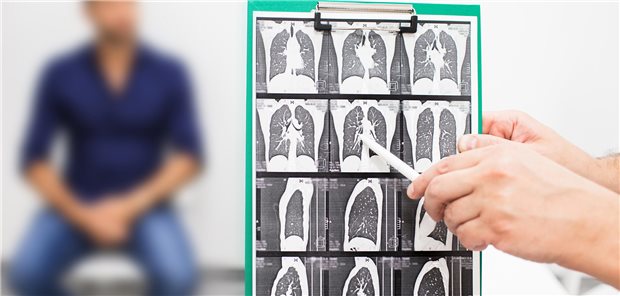 Wiedererweckte natürliche Killerzellen könnten Lungenfibrose rückgängig machen CT-Scan einer Lunge.