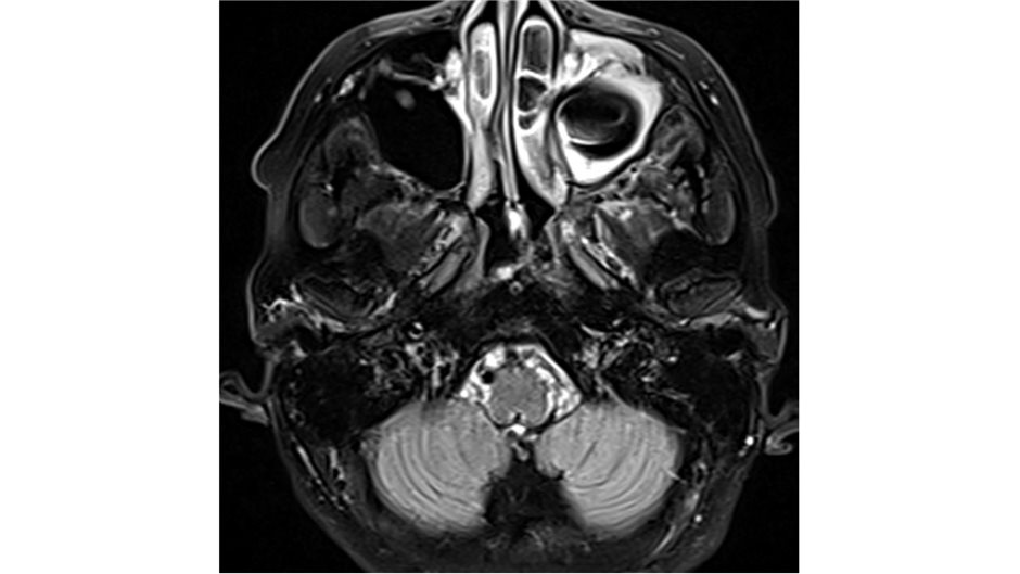 MRT-Aufnahmen vom 6. Dezember mit Befund einer Sinusitis maxillaris (Abbildungen 1, 2 und 3)