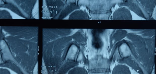 Axiale Spondyloarthritis: NSAR-Pause vor der MRT? MRT-Aufnahme zur Diagnosesicherung einer axialen Spondyloarthritis.