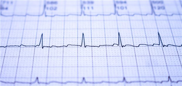 Vorhofflimmern: Welche Rolle die Rhythmuskontrolle für die Antikoagulation spielt EGK zeigt Vorhofflimmern