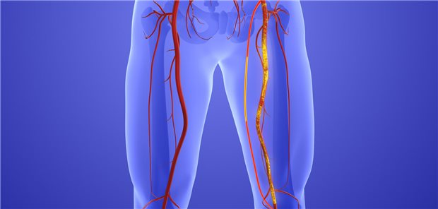 Mehr als „nur“ die Gefäße: Personen mit pAVK sind bekanntlich meist auch von anderen Erkrankungen – wie Diabetes, Hypertonie oder Adipositas – betroffen.