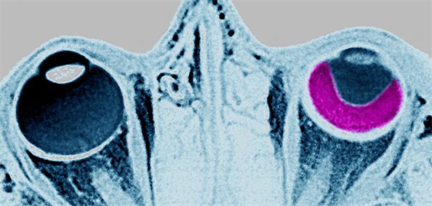 Netzhautablösung: Warnzeichen rechtzeitig erkennen MRT-Bild eines Schädels, das im linken Auge eine Netzhautablösung zeigt.