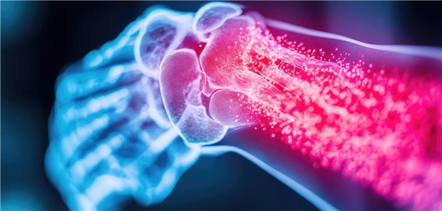 Entzündung bei Rheumatoider Arthritis unter Kontrolle, Knochendichte stabil? – Von wegen! Entzündung im Handgelenk