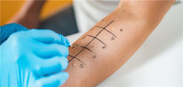 Tücken der Diagnostik bei Nahrungsmittelallergien: Welche Rolle Einzel-Allergene spielen Prick-zu-Prick-Test
