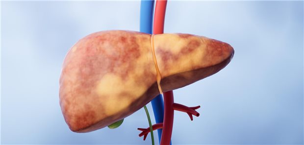 Patienten mit Leberfibrose und -zirrhose bald heilbar? Modell einer verfetteten Leber
