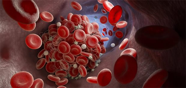 Vorhofflimmern: DOAK auch bei geringem Schlaganfall-Risiko einsetzen? Thrombus im Gefäß