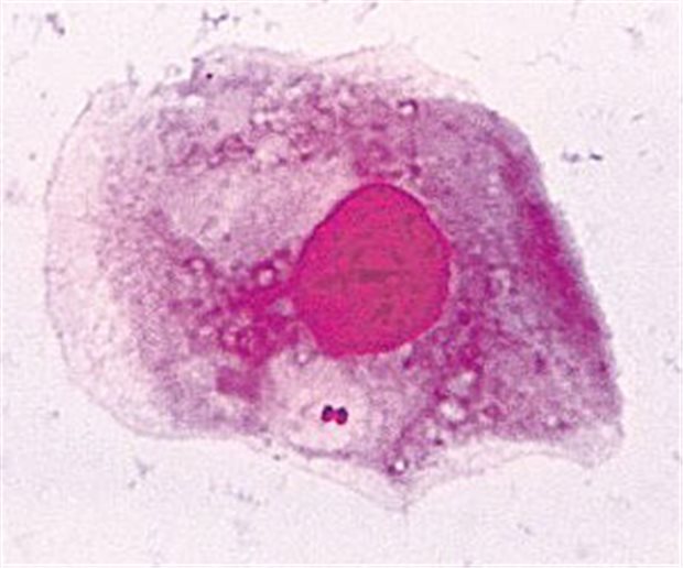 Neisseria meningitidis Infektion