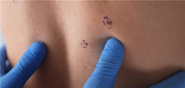 Darf der Intimbereich beim Hautkrebs-Screening ausgelassen werden? Ein Dermatologe mit blauen Handschuhen untersucht im Rahmen einer Hautkrebsvorsorgeuntersuchung die durch einen Kreis als auffällig markierten Muttermale auf dem Rücken eines Mannes.