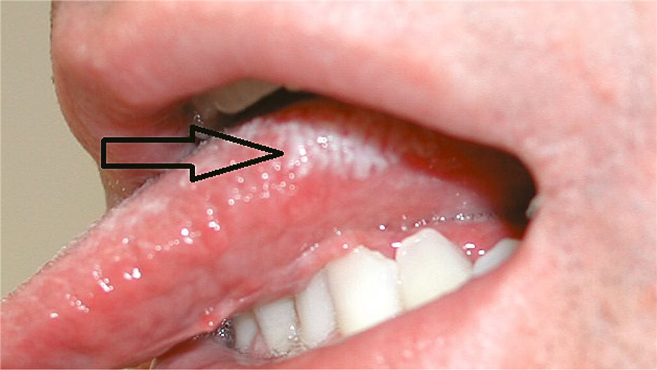 Orale Haarleukoplakie: Asymptomatische, nicht abwischbare weißliche Verhornung a...