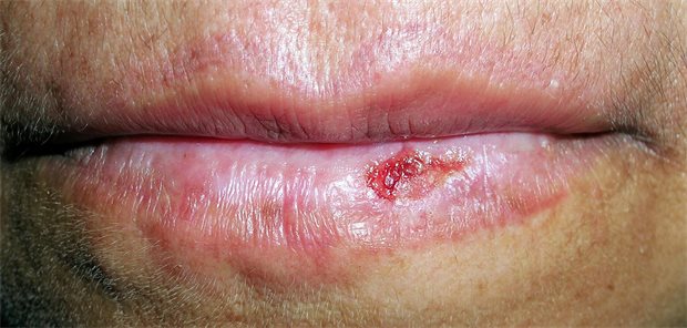 Von Pemphigus bis SJS: Was tun gegen die Blasen im Mund? Eine verkrustete Blase auf der Lippe eines Mannes.