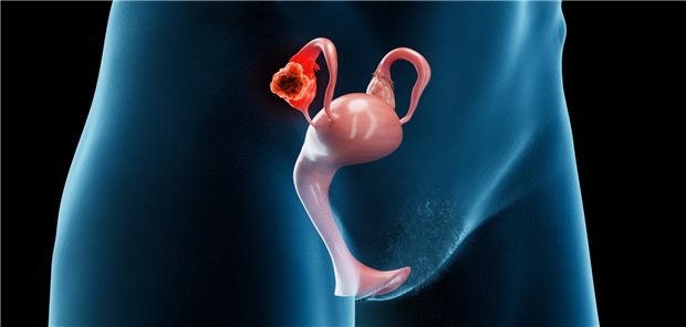Ovarialkarzinom: Neue Therapiestrategien derzeit in der Mache 3D-Rendering eines weiblichen Unterleibs. Auf einem Eierstock ist ein Tumor zu erkennen.