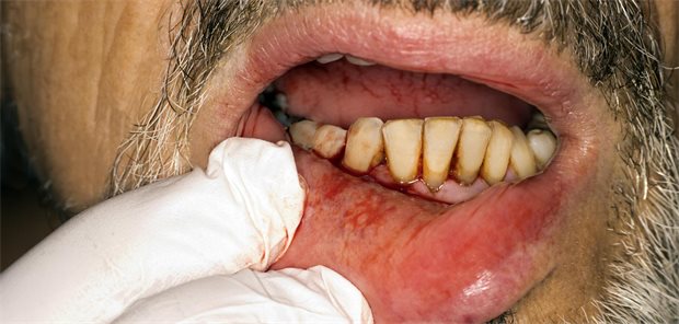 Parodontitis: Unterschätzte Komplikation bei Diabetes Parodontitis, stark blutendes Zahnfleisch