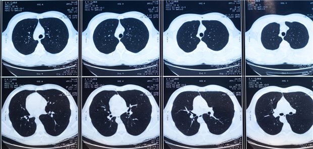 Warum das Screening auf Lungenkrebs für die HNO-Medizin interessant ist Aufnahmen einer CT-Untersuchungen der Lunge zur Diagnose einer möglichen Lungenerkrankungen.