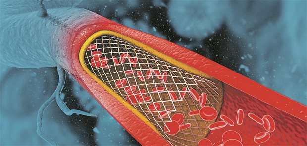 Welche KHK-Patienten von längerer DAPT profitieren könnten Patienten mit Stent erhielten in einer chinesischen Studie für ganze zwei Jahre nach Stent-Implantation eine duale Antiplättchen-Therapie (DAPT).